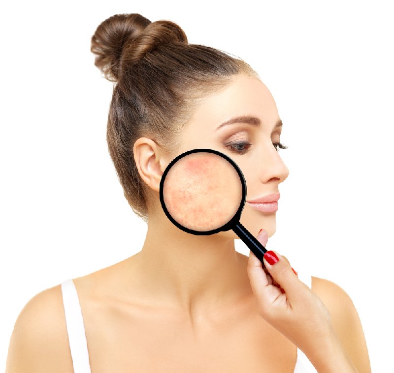 Co to jest trądzik różowaty?